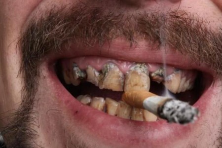 吸烟和牙齿问题有关系吗？