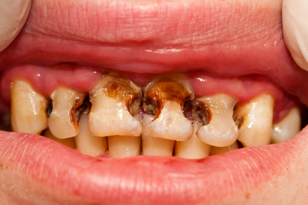 这就是吸烟对牙齿、口腔和牙龈的影响！