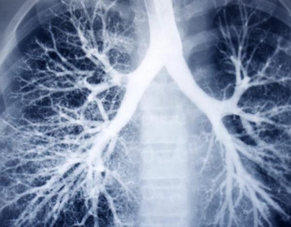 吸烟与慢性阻塞性肺病之间有什么联系？